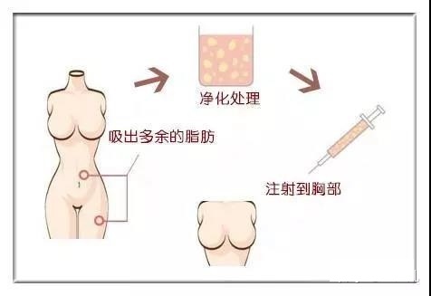 脂肪丰胸